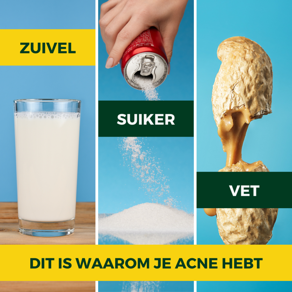 dit is waarom je acne hebt zuivel suiker en vet afbeelding melk, suiker en pinda